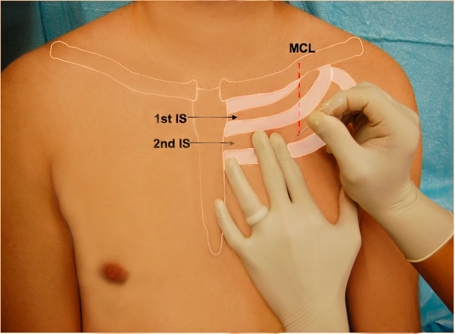Needle Decompression waxed